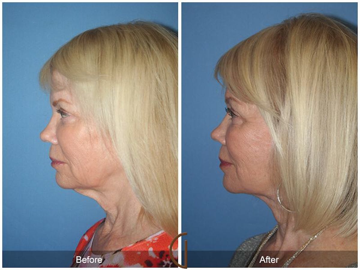 Facelift 60s Before & After Gallery - Patient 158240 - Image 1