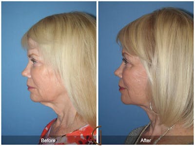 Neck Lift Before & After Gallery - Patient 655612 - Image 1