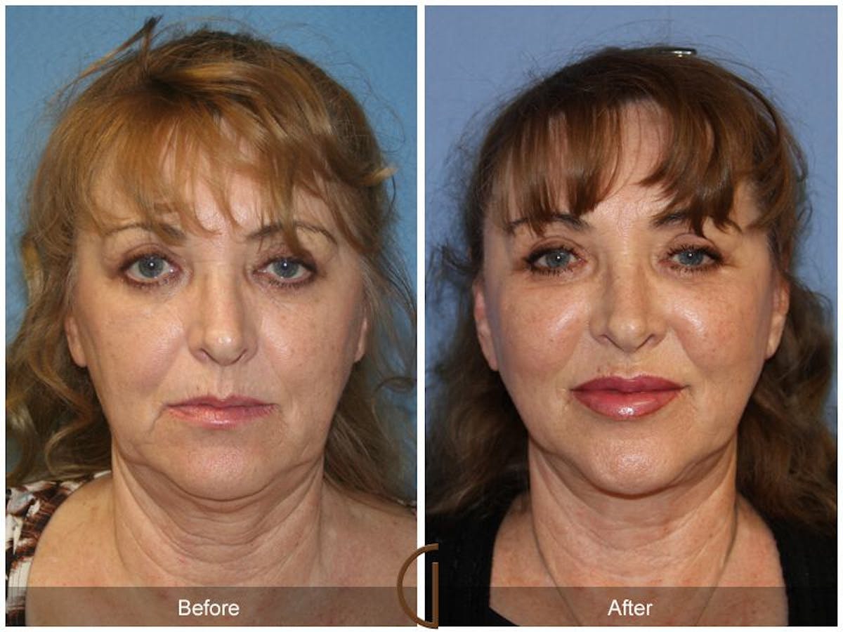 Facelift 60s Before & After Gallery - Patient 269397 - Image 2