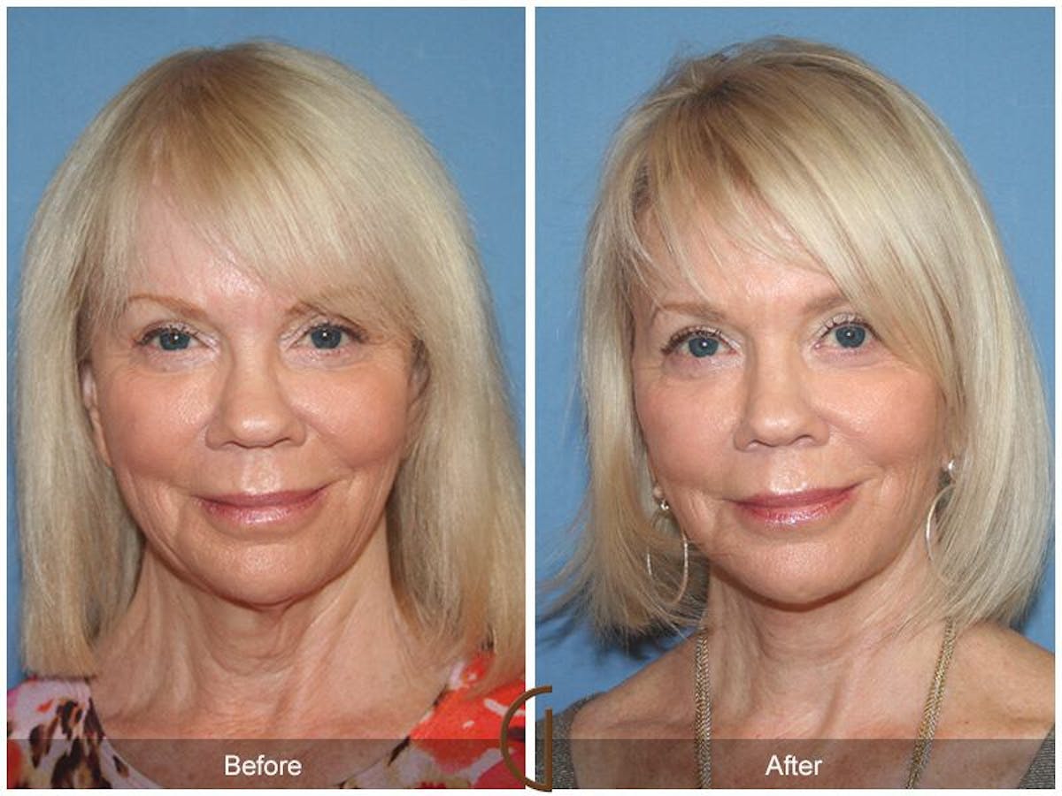 Facelift 60s Before & After Gallery - Patient 158240 - Image 2