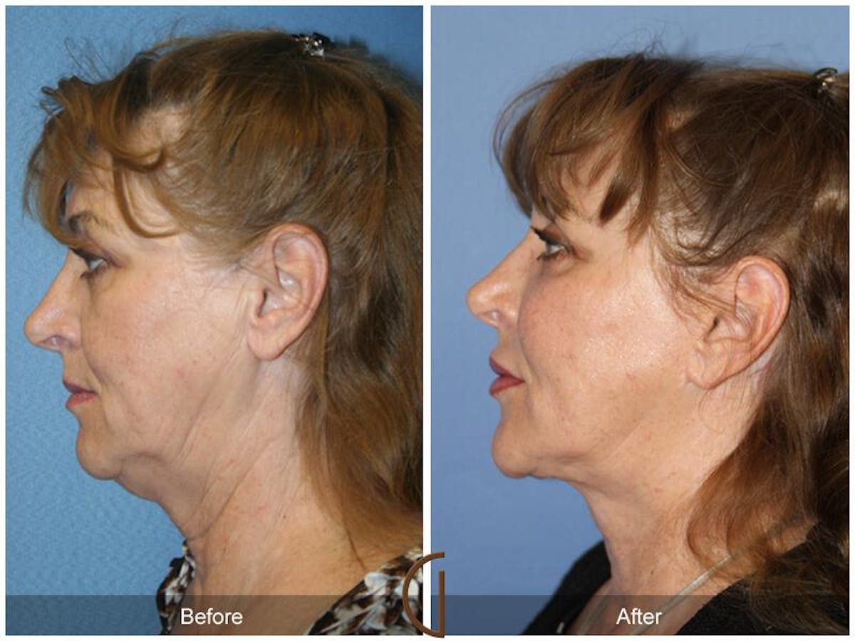 Facelift 60s Before & After Gallery - Patient 269397 - Image 1