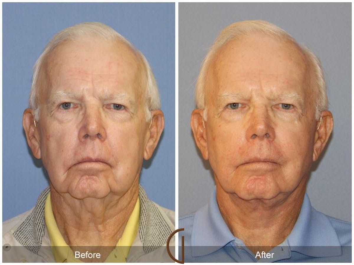 Neck Lift Before & After Gallery - Patient 373319 - Image 2