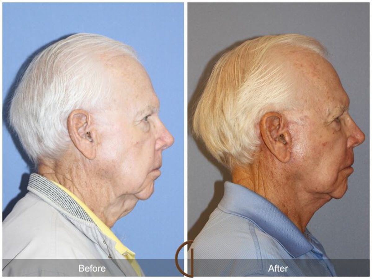 Neck Lift Before & After Gallery - Patient 373319 - Image 3