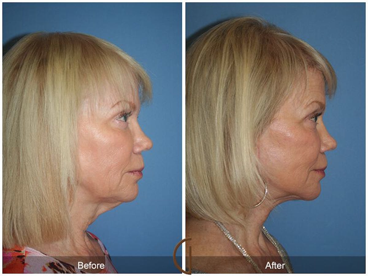 Facelift 60s Before & After Gallery - Patient 158240 - Image 3