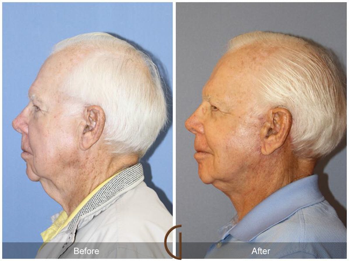 Neck Lift Before & After Gallery - Patient 373319 - Image 1
