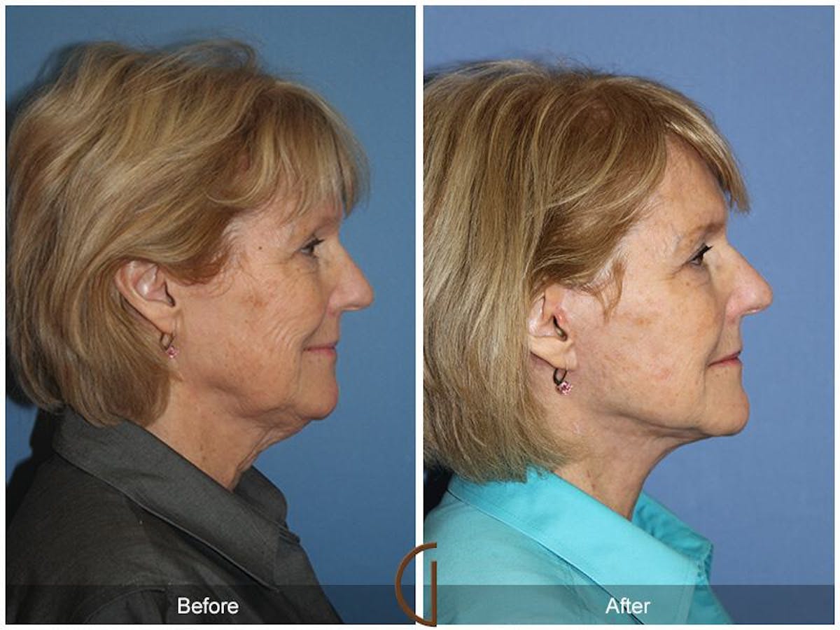 Facelift 60s Before & After Gallery - Patient 150585 - Image 3