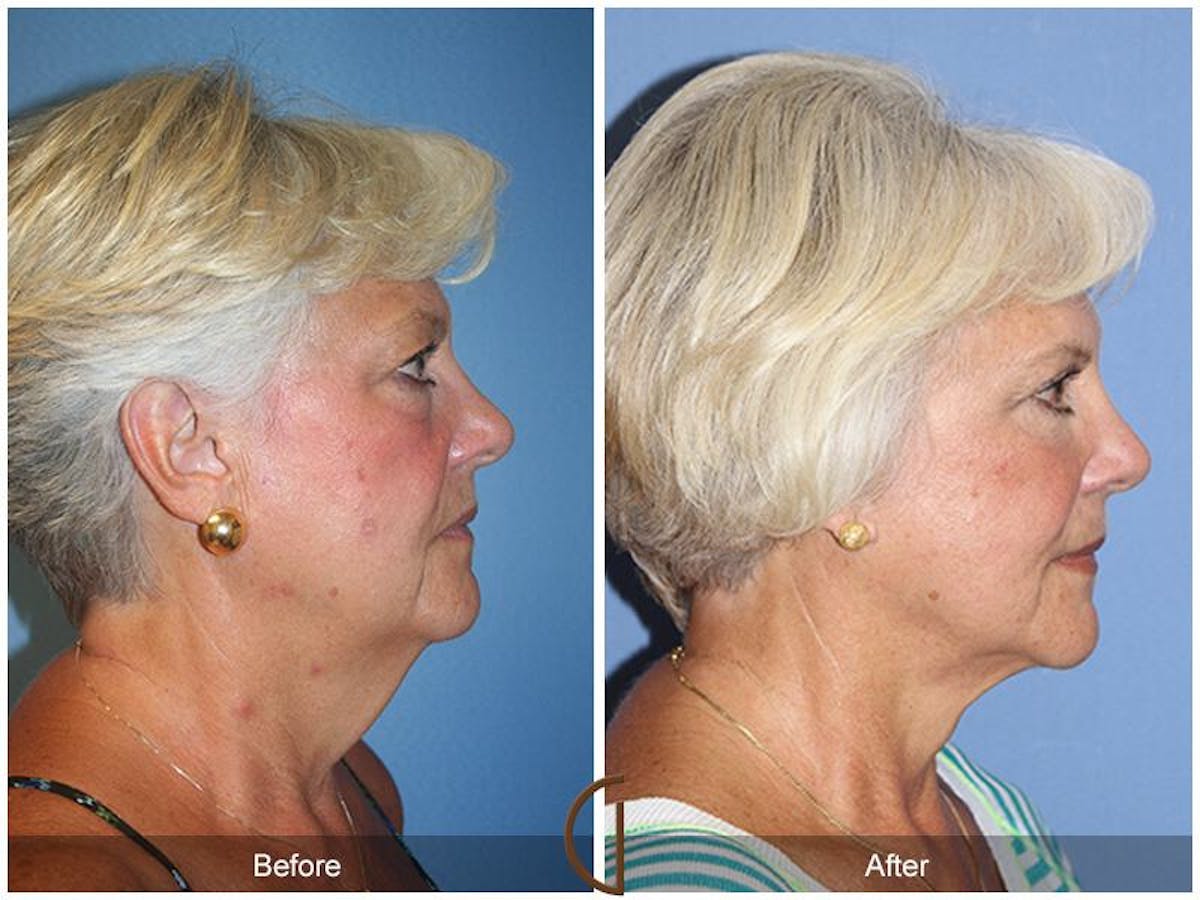 Facelift 60s Before & After Gallery - Patient 319138 - Image 3
