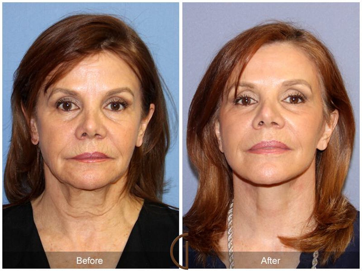 Facelift 60s Before & After Gallery - Patient 327411 - Image 2