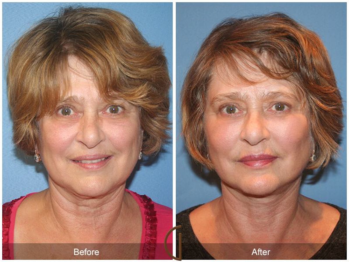 Facelift 60s Before & After Gallery - Patient 184502 - Image 2