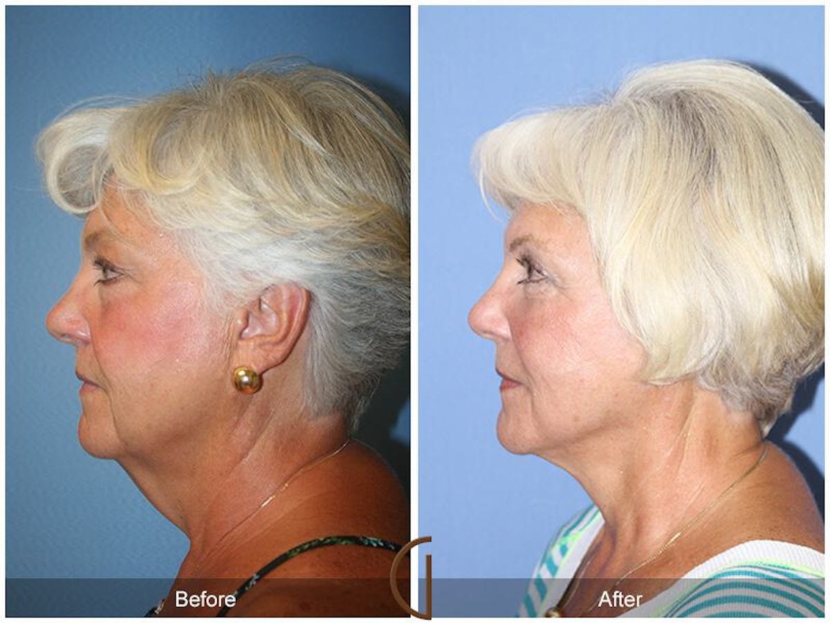 Facelift 60s Before & After Gallery - Patient 319138 - Image 1