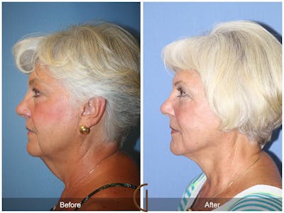 Neck Lift Before & After Gallery - Patient 274017 - Image 1