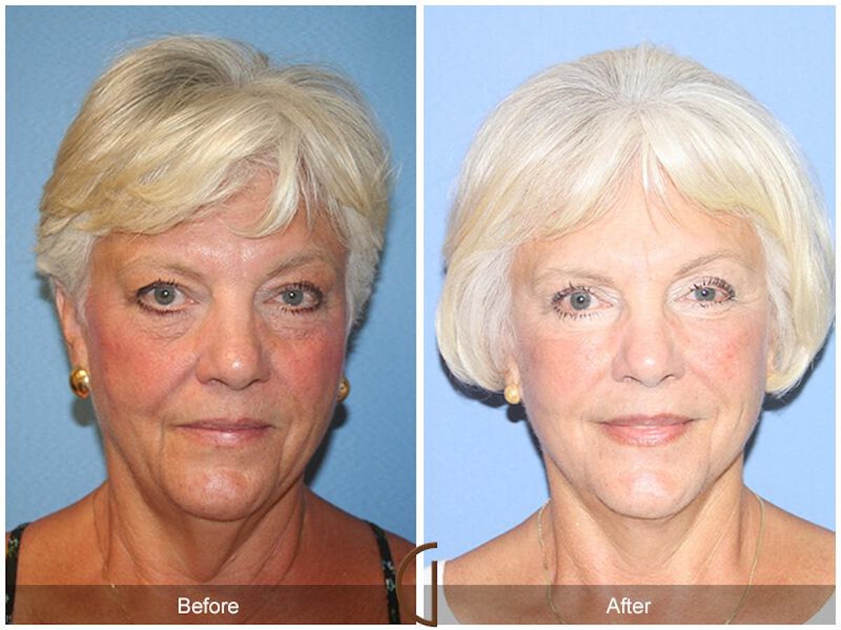 Facelift 60s Before & After Gallery - Patient 319138 - Image 2