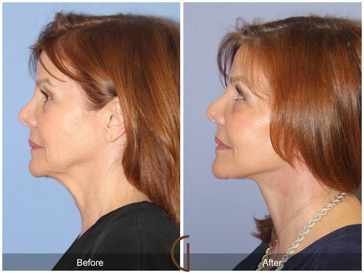 Facelift 60s Before & After Gallery - Patient 327411 - Image 1
