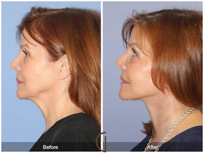 Neck Lift Before & After Gallery - Patient 320462 - Image 1