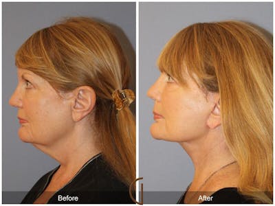 Neck Lift Before & After Gallery - Patient 318603 - Image 1