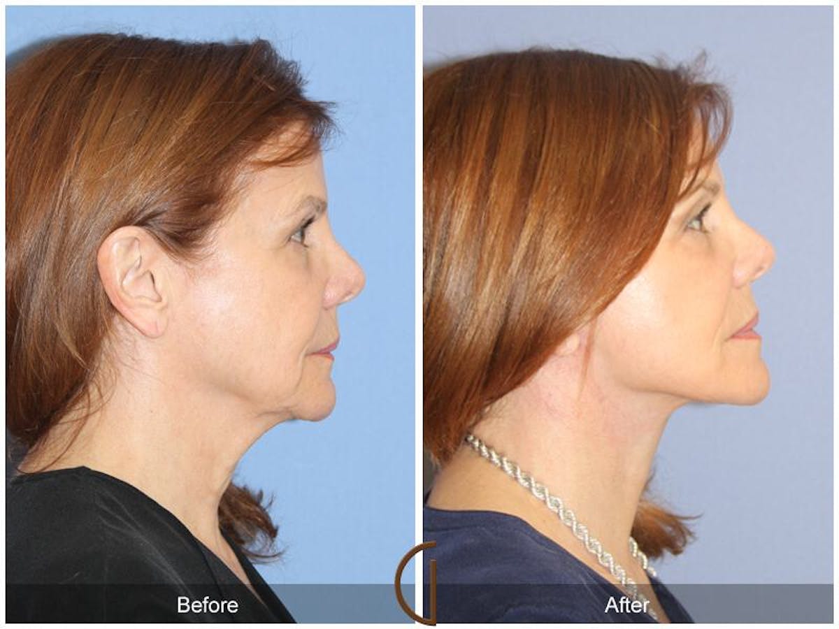 Facelift 60s Before & After Gallery - Patient 327411 - Image 3
