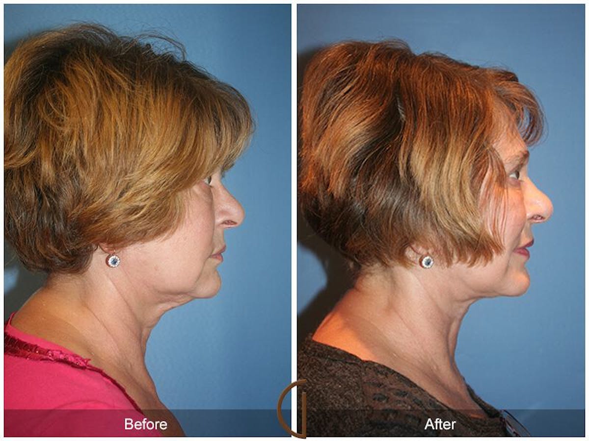 Facelift 60s Before & After Gallery - Patient 184502 - Image 3