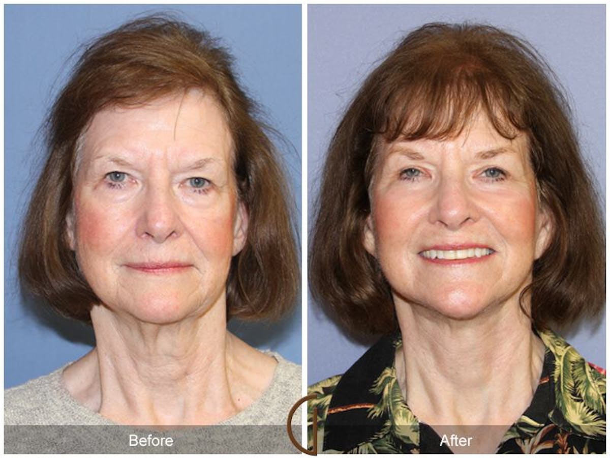 Facelift 70s Before & After Gallery - Patient 186009 - Image 2