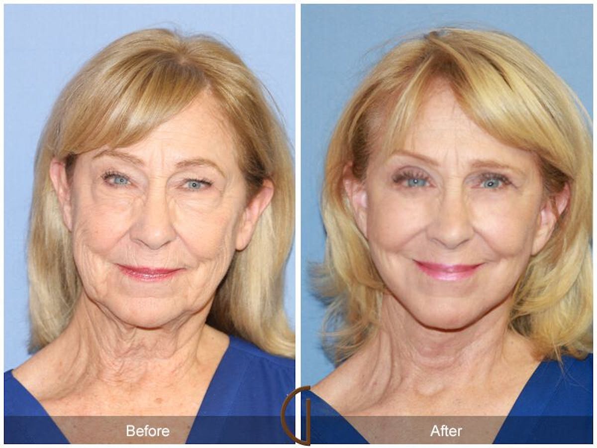 Facelift 70s Before & After Gallery - Patient 106358 - Image 2