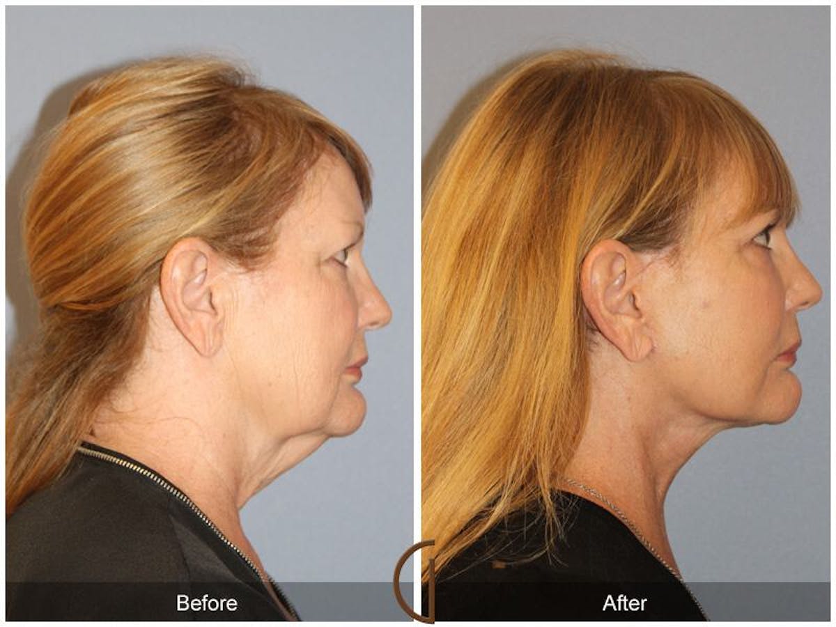 Facelift 60s Before & After Gallery - Patient 249085 - Image 3