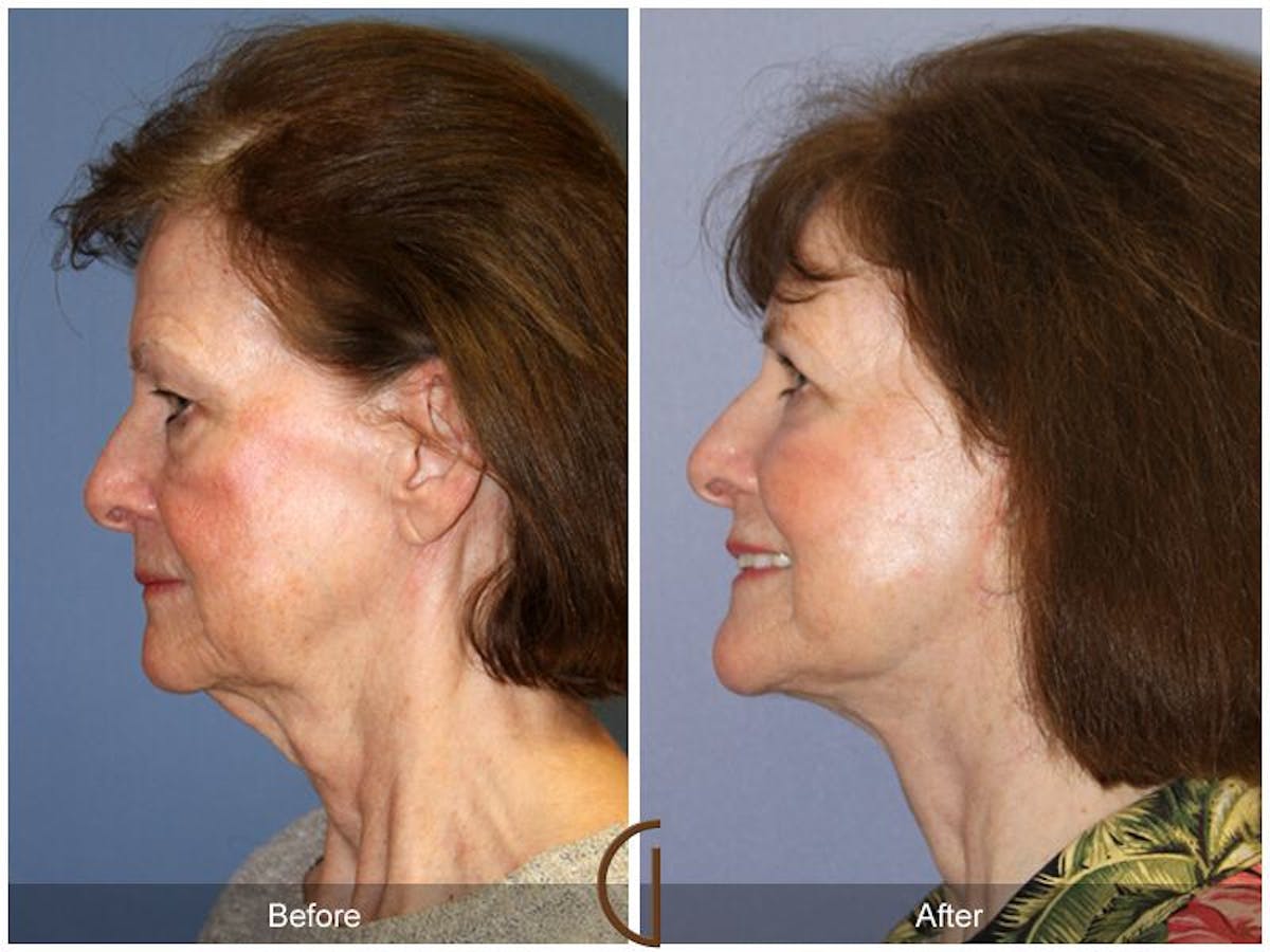 Facelift 70s Before & After Gallery - Patient 186009 - Image 1