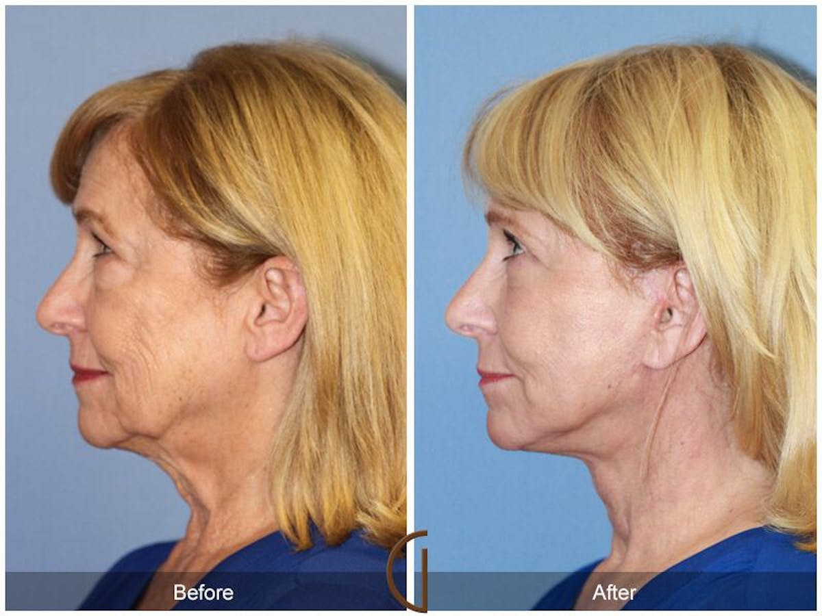 Facelift 70s Before & After Gallery - Patient 106358 - Image 1