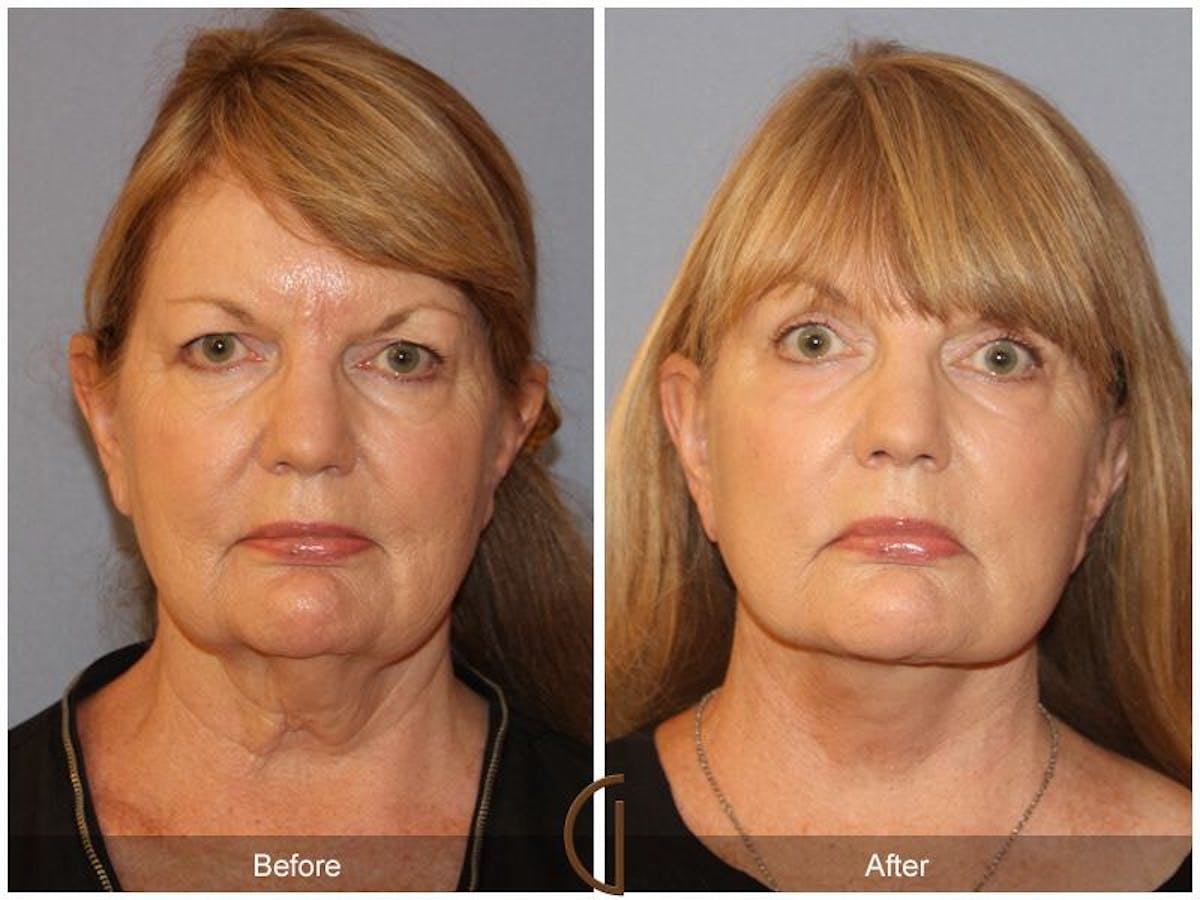 Facelift 60s Before & After Gallery - Patient 249085 - Image 2