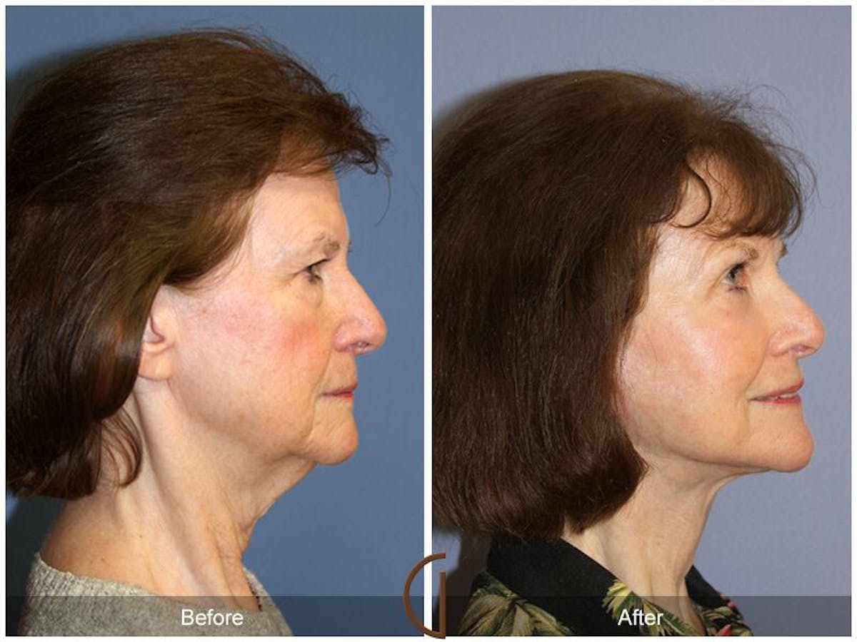 Facelift 70s Before & After Gallery - Patient 186009 - Image 3