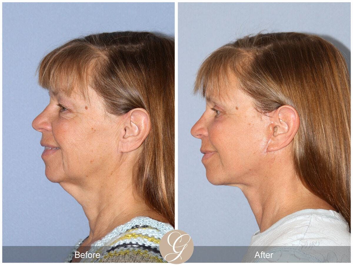 Neck Lift Before & After Gallery - Patient 353088 - Image 1