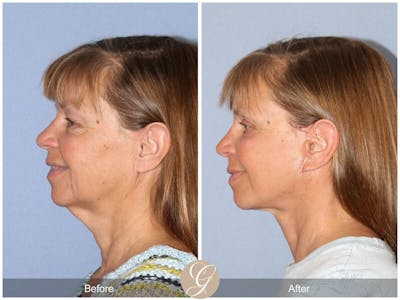 Neck Lift Before & After Gallery - Patient 353088 - Image 1