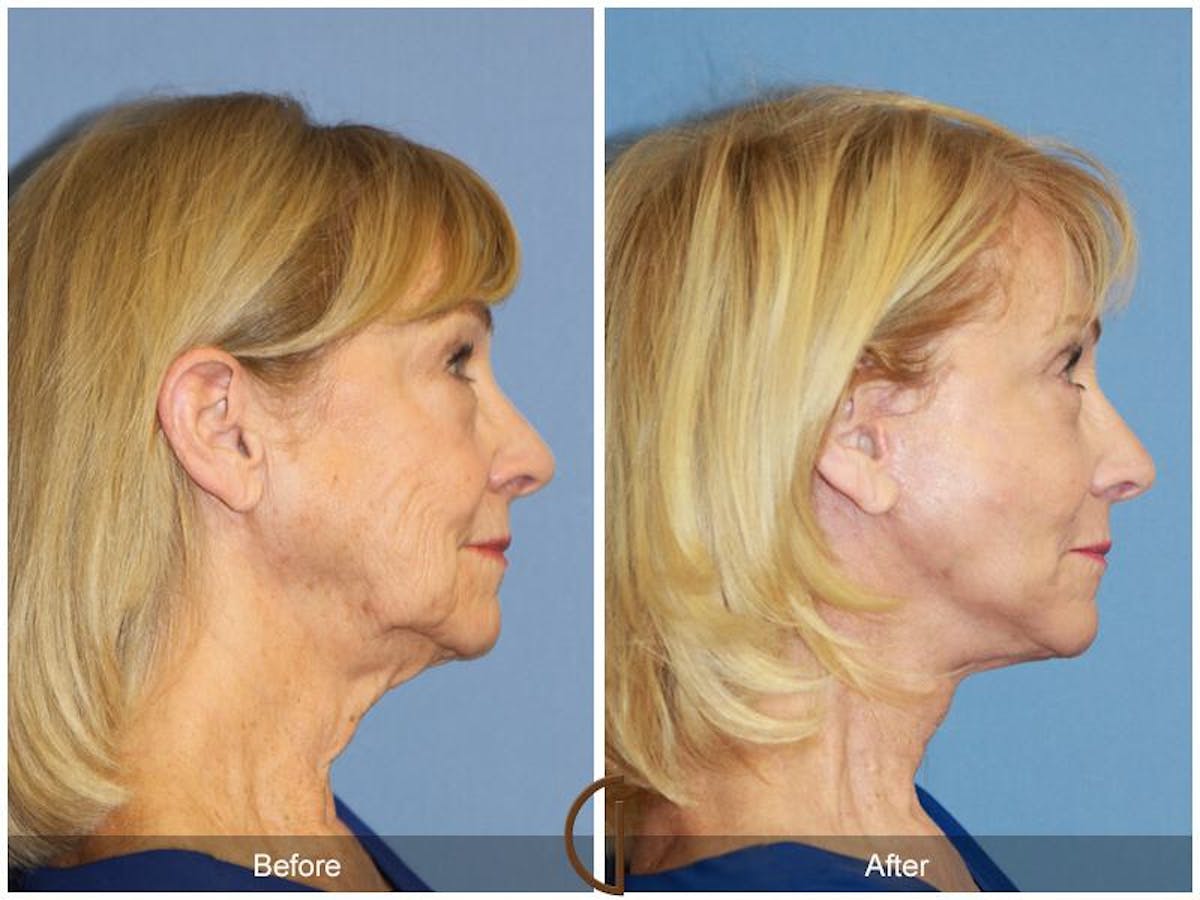 Facelift 70s Before & After Gallery - Patient 106358 - Image 3
