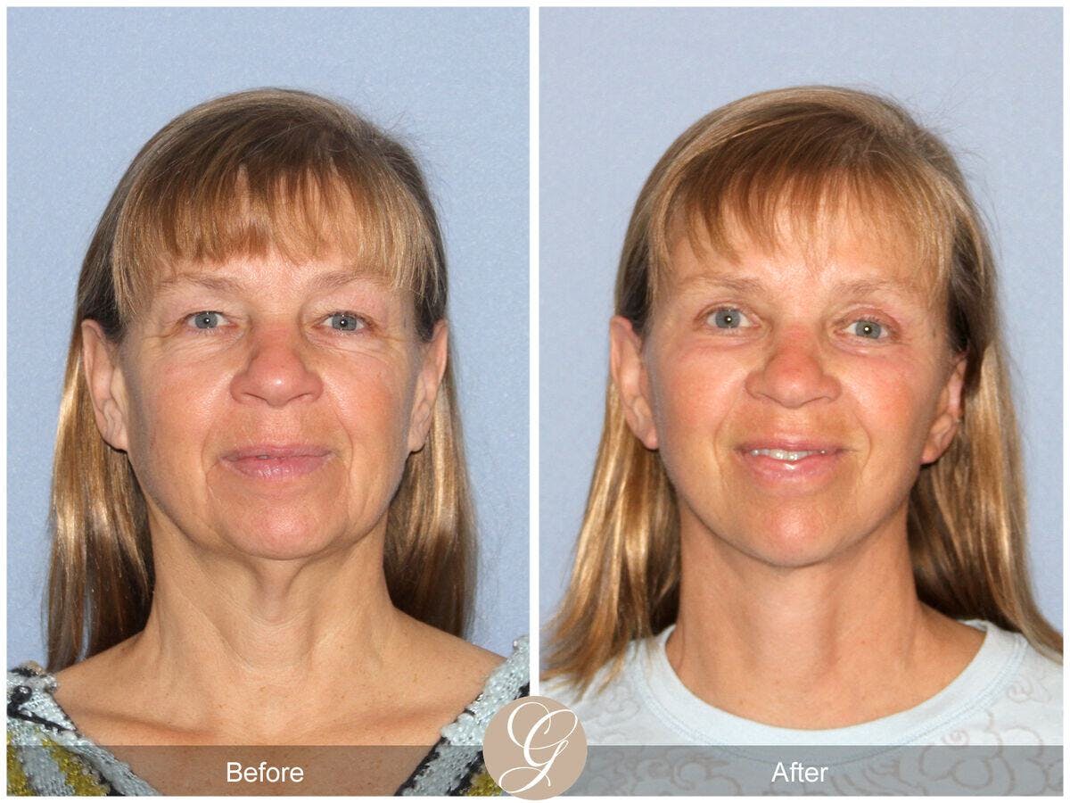 Neck Lift Before & After Gallery - Patient 353088 - Image 2