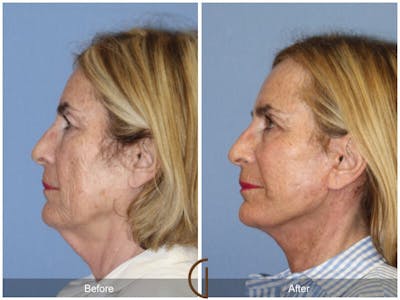 Neck Lift Before & After Gallery - Patient 238598 - Image 1