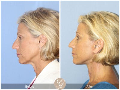 Neck Lift Before & After Gallery - Patient 428549 - Image 1