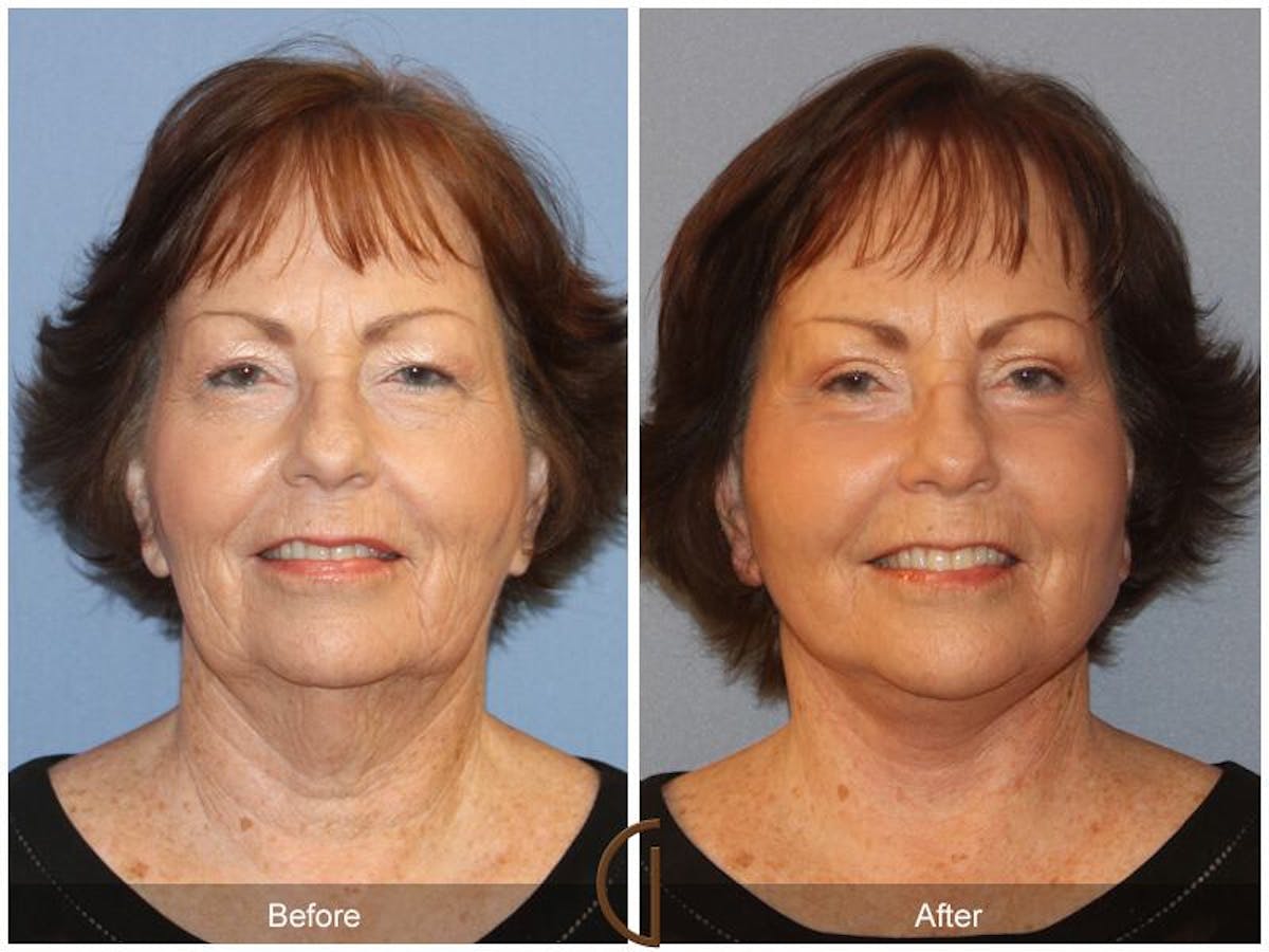 Facelift 60s Before & After Gallery - Patient 387516 - Image 2