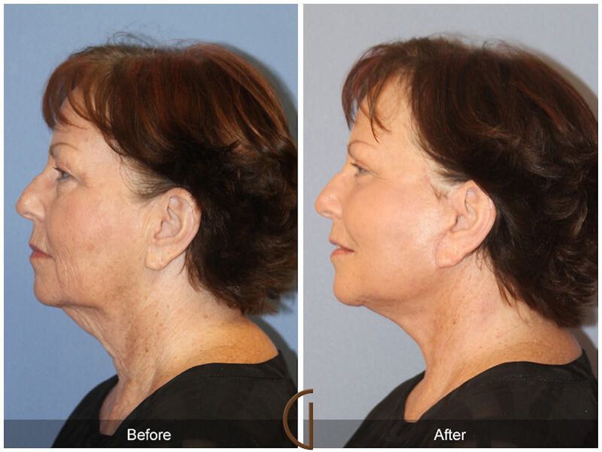 Facelift 60s Before & After Gallery - Patient 387516 - Image 1