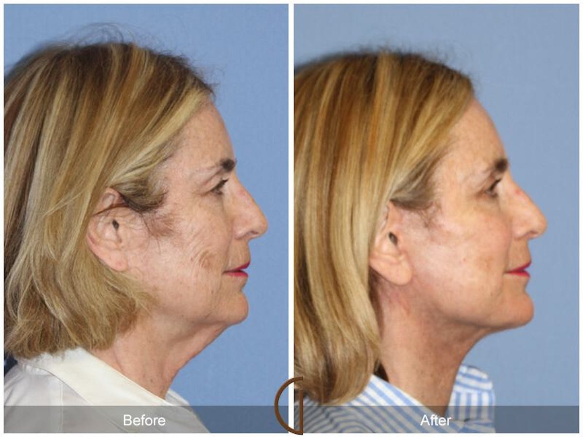 Facelift 60s Before & After Gallery - Patient 800057 - Image 3