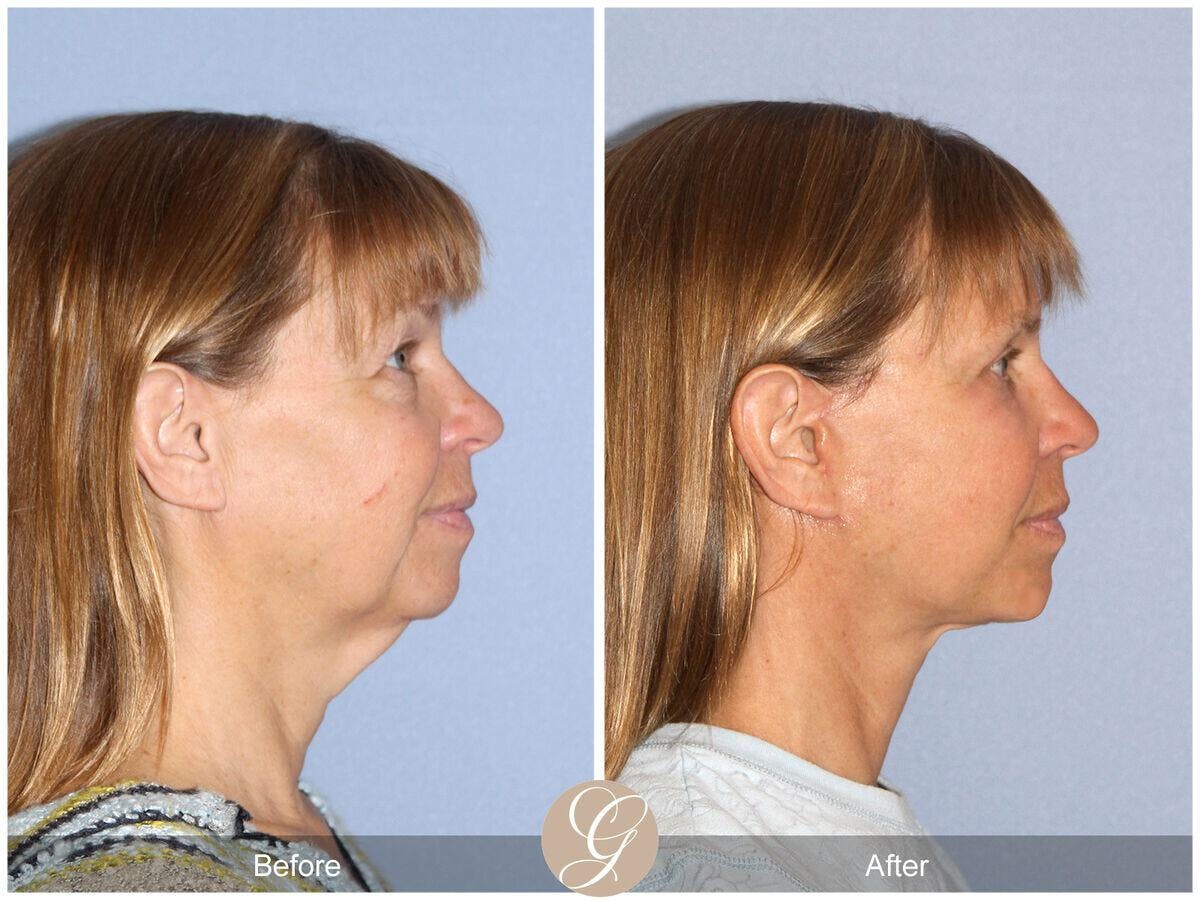 Neck Lift Before & After Gallery - Patient 353088 - Image 3