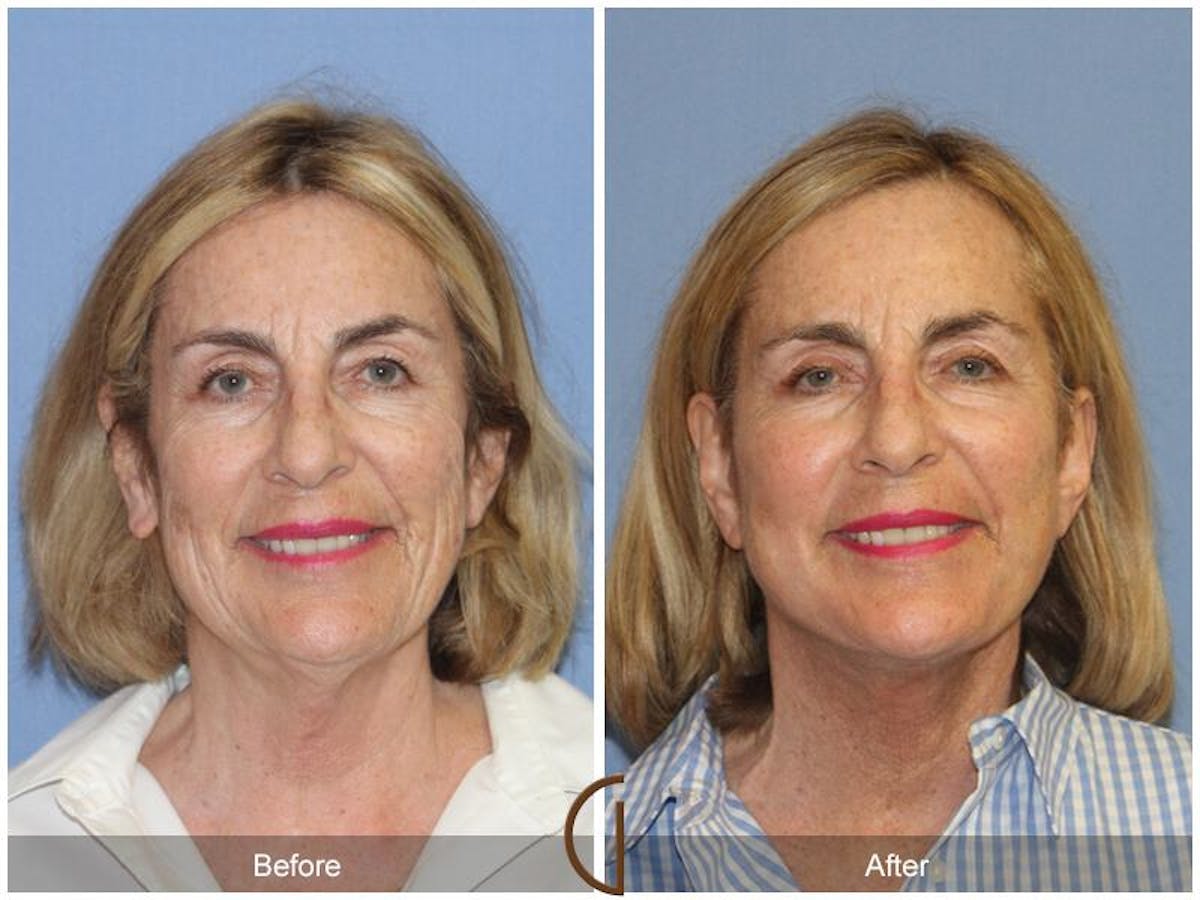 Facelift 60s Before & After Gallery - Patient 800057 - Image 2