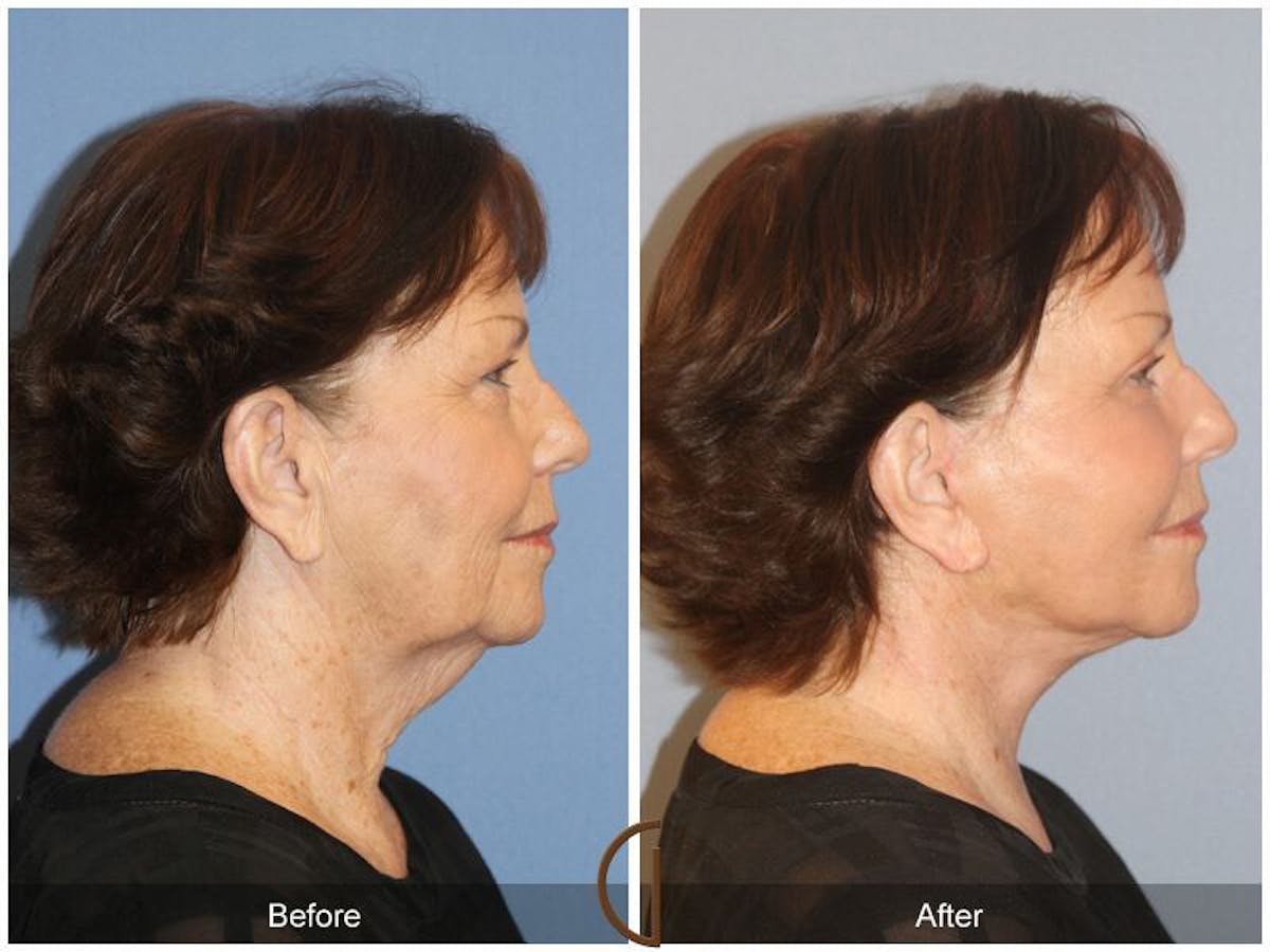 Facelift 60s Before & After Gallery - Patient 387516 - Image 3