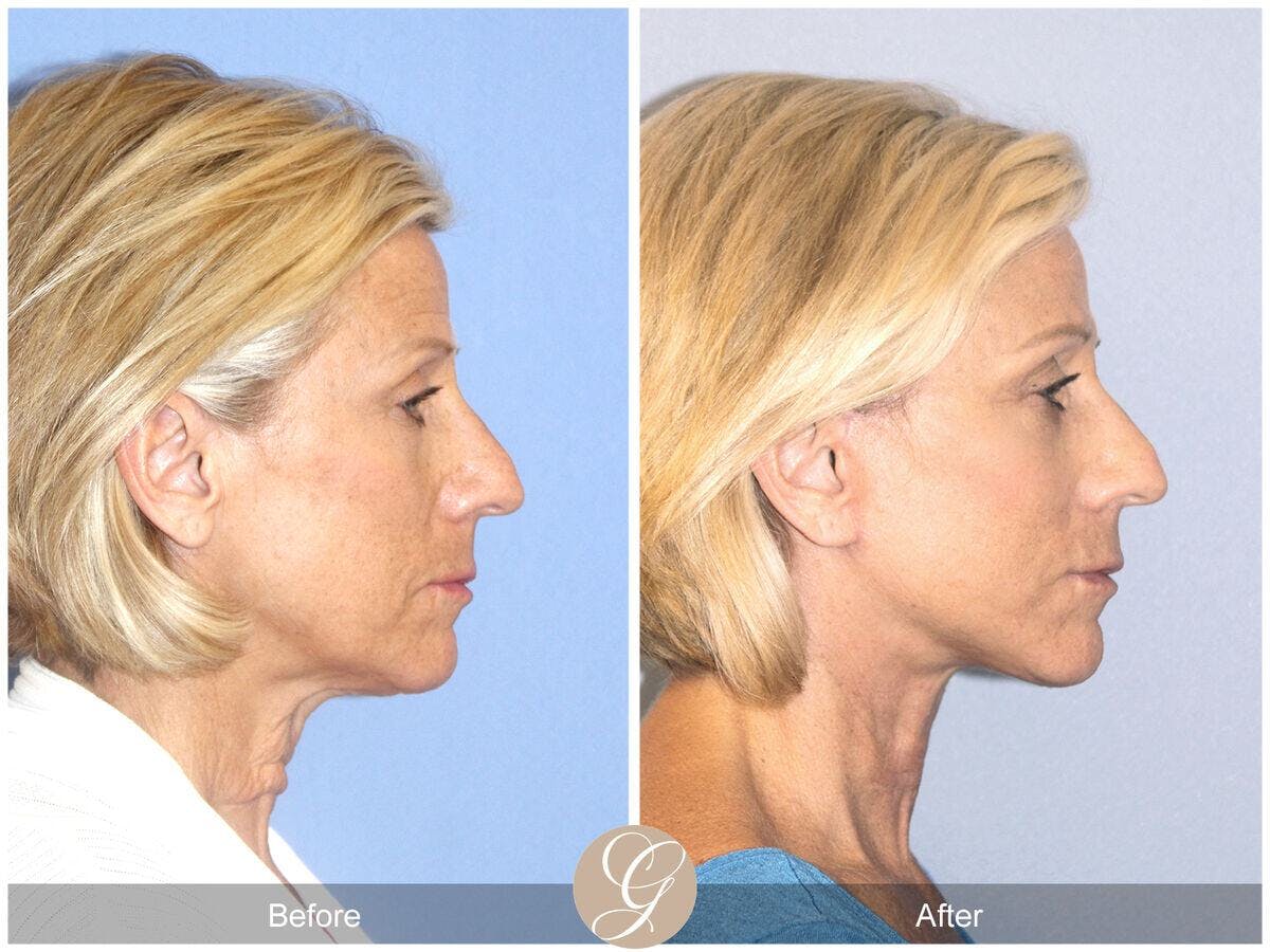 Facelift 60s Before & After Gallery - Patient 425558 - Image 3