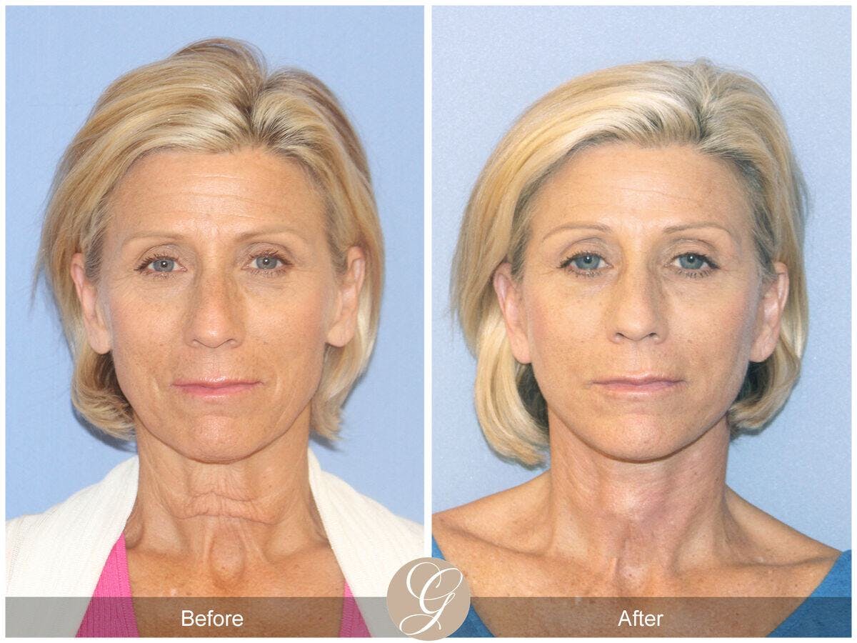 Facelift 60s Before & After Gallery - Patient 425558 - Image 2