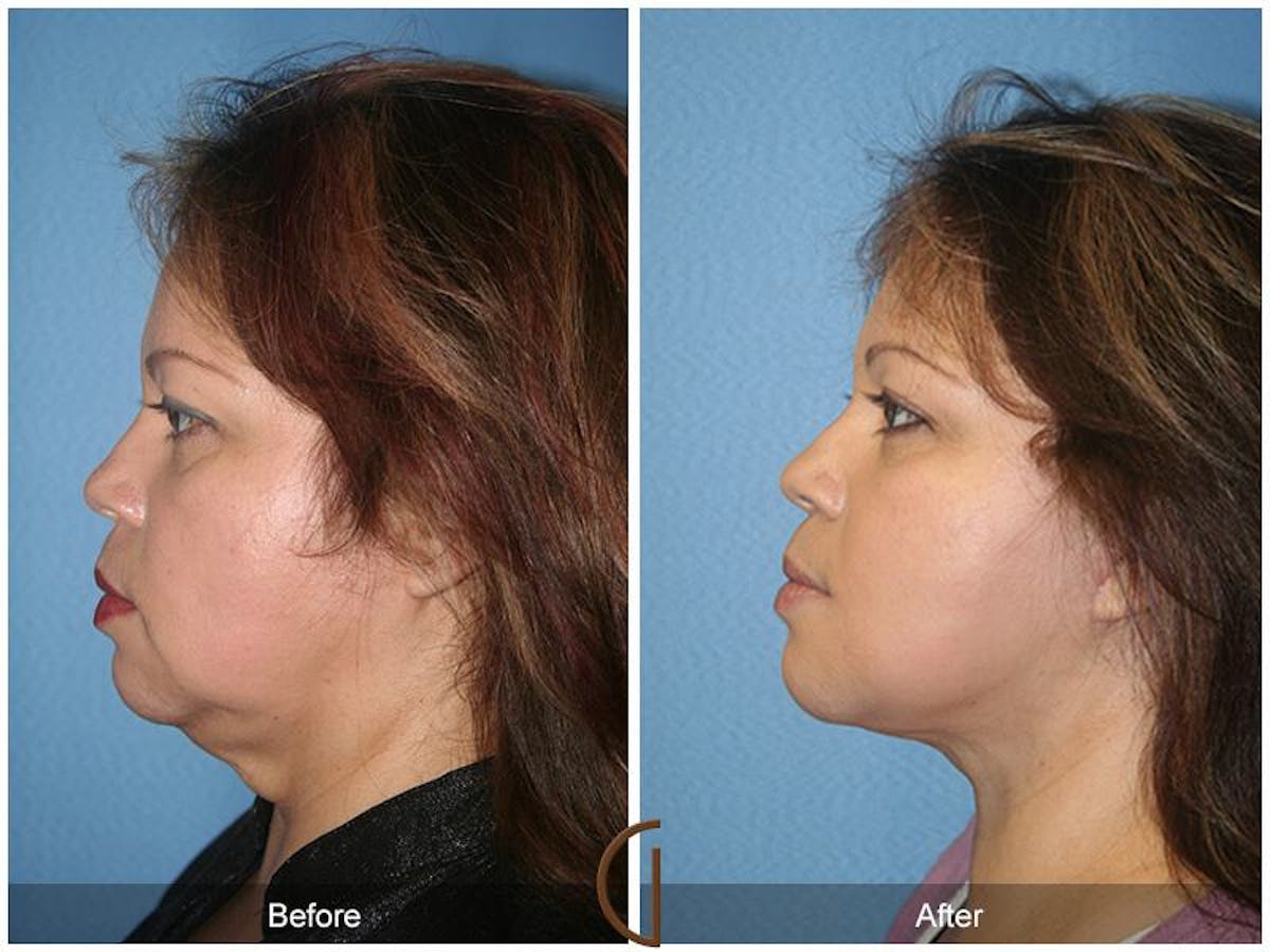 Facelift 40s Before & After Gallery - Patient 333255 - Image 1