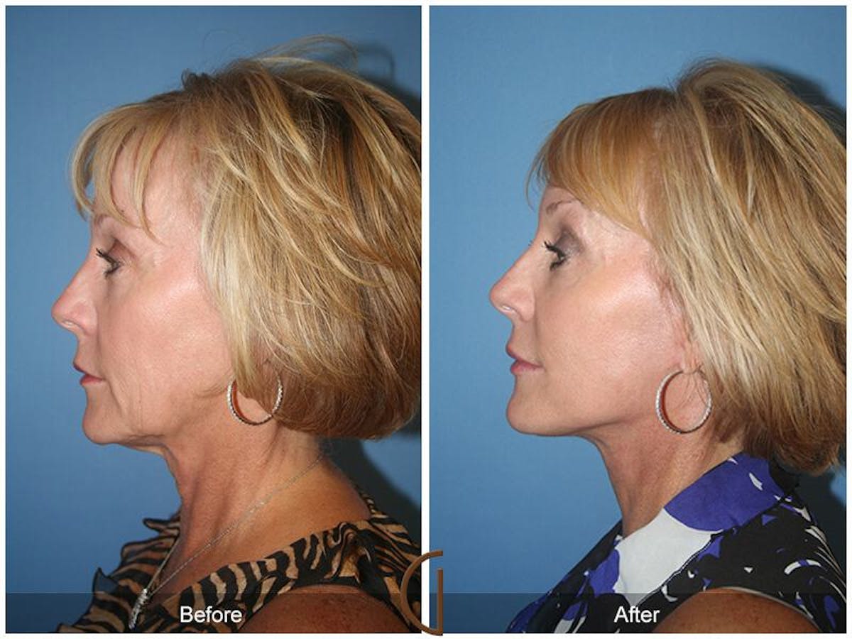 Facelift 60s Before & After Gallery - Patient 146861 - Image 1