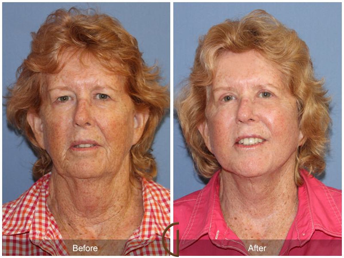Facelift 70s Before & After Gallery - Patient 399650 - Image 2