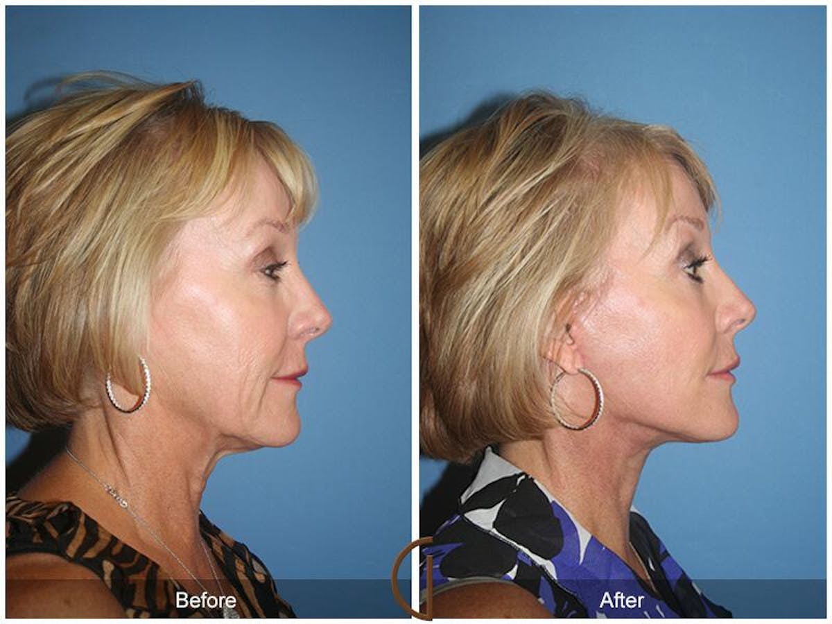 Facelift 60s Before & After Gallery - Patient 146861 - Image 3