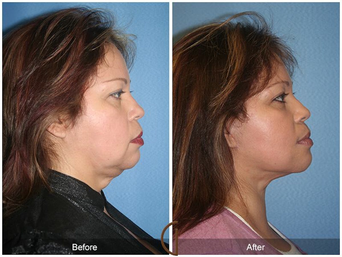Facelift 40s Before & After Gallery - Patient 333255 - Image 3