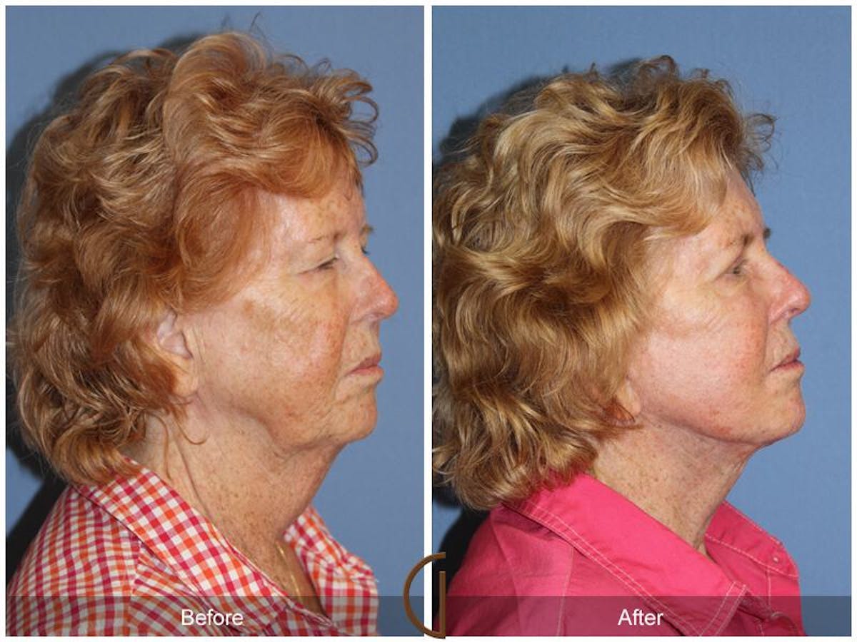 Facelift 70s Before & After Gallery - Patient 399650 - Image 3