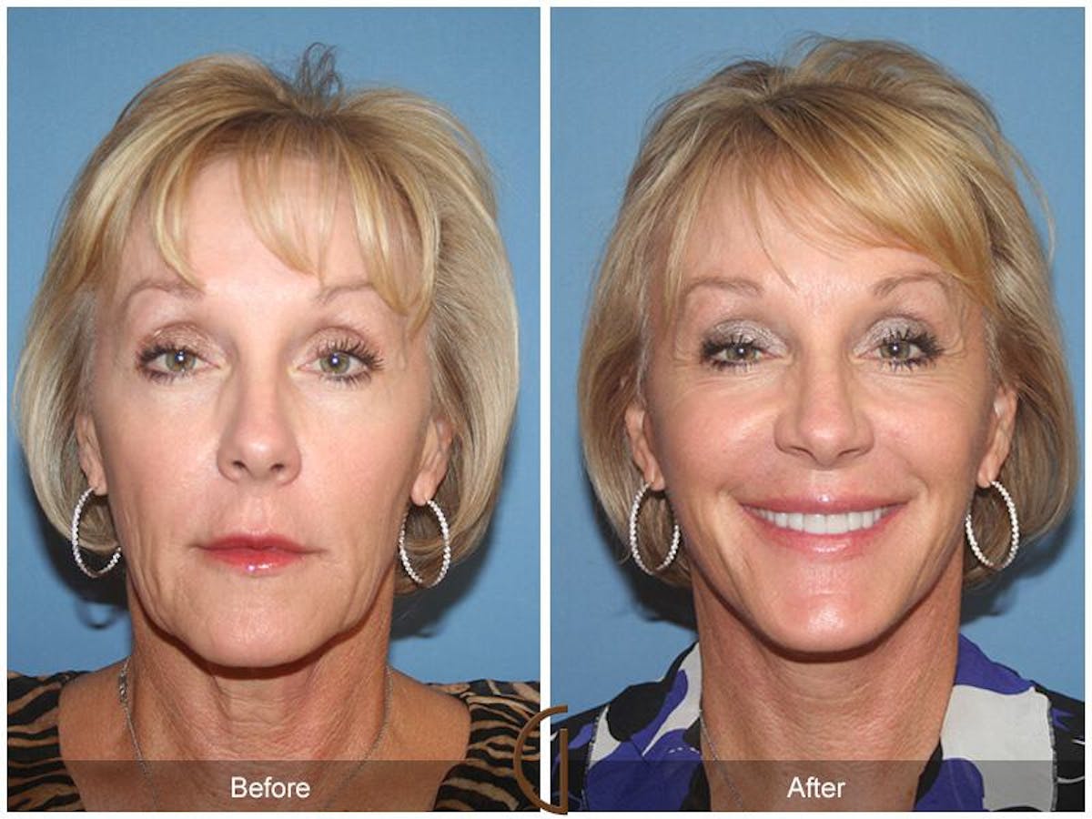Facelift 60s Before & After Gallery - Patient 146861 - Image 2