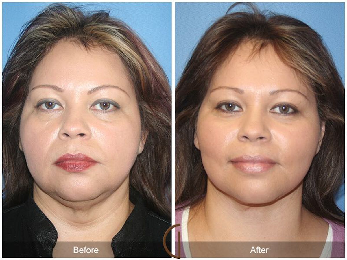Facelift 40s Before & After Gallery - Patient 333255 - Image 2